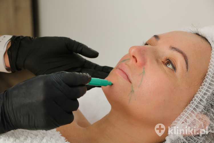 Nici liftingujące z haczykami są stosowane głównie do wyraźnego unoszenia opadających tkanek