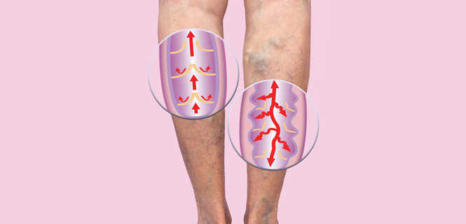 Nowoczesne metody leczenia żylaków kończyn dolnych
