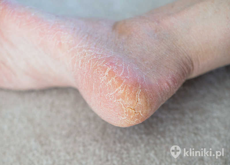 Pękające pięty często są wynikiem przesuszenia naskórka, dlatego kluczowa jest codzienna pielęgnacja stóp Pękające pięty często są wynikiem przesuszenia naskórka, dlatego kluczowa jest codzienna pielęgnacja stóp