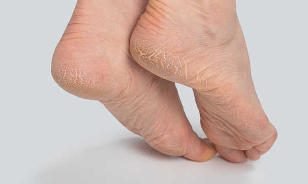 Pękające pięty, nieleczone, mogą prowadzić do bólu i nadkażeń, dlatego nie należy ich bagatelizować Pękające pięty, nieleczone, mogą prowadzić do bólu i nadkażeń, dlatego nie należy ich bagatelizować