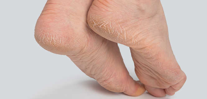 Leczenie pękających pięt
