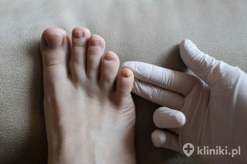 Skuteczne leczenie grzybicy paznokci często wspiera właściwa higiena stóp i paznokci oraz regularna dezynfekcja obuwia Skuteczne leczenie grzybicy paznokci często wspiera właściwa higiena stóp i paznokci oraz regularna dezynfekcja obuwia