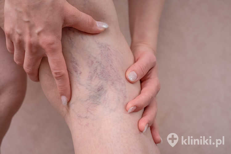 Specjalistyczna konsultacja flebologiczna zwykle obejmuje wywiad medyczny oraz badanie USG Doppler