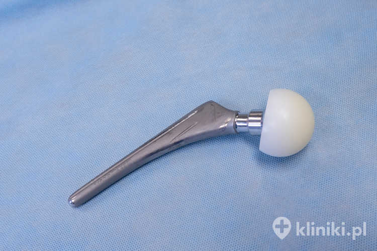 Sztuczny staw biodrowy zmniejsza dolegliwości bólowe poprzez eliminację tarcia zniszczonych powierzchni stawowych