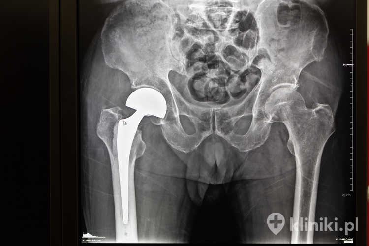 Ten rodzaj endoprotezoplastyki stawu biodrowego zalecany jest często osobom starszym z obniżoną jakością kości