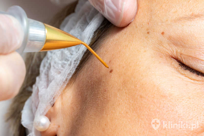 Zabieg laserowego usuwania zmian skórnych pozwala na precyzyjne usunięcie zmiany z minimalnym uszkodzeniem tkanek