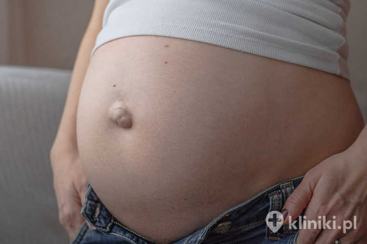 Przepuklina pępkowa w ciąży
