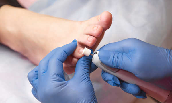 Rekonstrukcja płytki paznokcia polega na odtworzeniu jej kształtu i funkcji po urazie, chorobie lub zabiegu Rekonstrukcja płytki paznokcia polega na odtworzeniu jej kształtu i funkcji po urazie, chorobie lub zabiegu