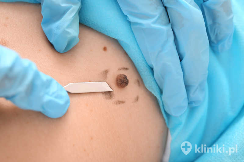 Usunięcie chirurgiczne zmiany skórnej jest często stosowane w celu leczenia zmian podejrzanych o nowotworzenie Usunięcie chirurgiczne zmiany skórnej jest często stosowane w celu leczenia zmian podejrzanych o nowotworzenie