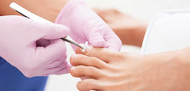 Usunięcie wrastającego paznokcia