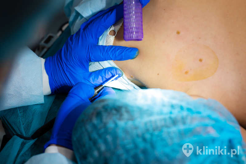 Usunięcie zmiany skórnej operacyjnie wymaga często miejscowego znieczulenia i krótkiego czasu rekonwalescencji Usunięcie zmiany skórnej operacyjnie wymaga często miejscowego znieczulenia i krótkiego czasu rekonwalescencji