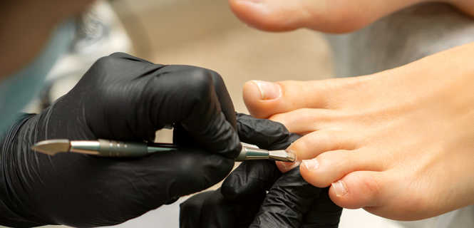 Usuwanie krwiaka podpaznokciowego