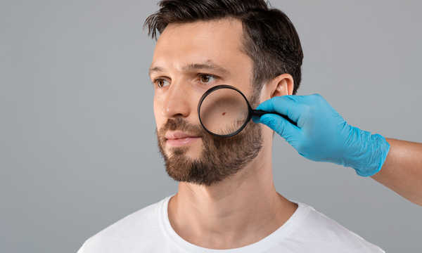 Zabieg chirurgiczny zmiany skórnej pozwala na dokładne pobranie materiału do badania histopatologicznego Zabieg chirurgiczny zmiany skórnej pozwala na dokładne pobranie materiału do badania histopatologicznego