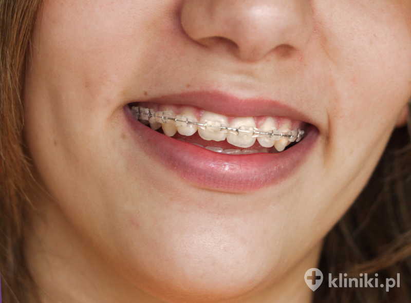 Chirurgia ortognatyczna może pomóc w leczeniu przewlekłych dolegliwości stawów skroniowo-żuchwowych