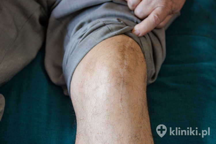 Implanty stosowane w endoprotezoplastyce stawu kolanowego projektowane są tak, aby jak najlepiej odwzorować anatomiczne kształty stawu i zapewnić optymalny zakres ruchu po operacji