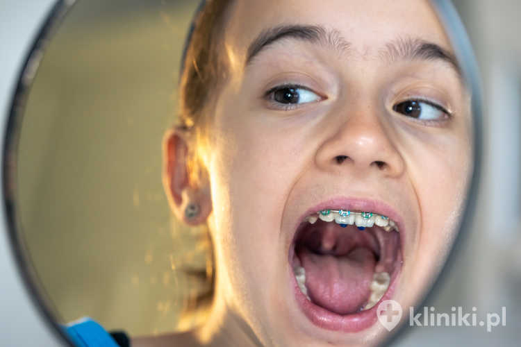 Krótkie wędzidełko języka jest najczęściej diagnozowane u niemowląt, ale bywa rozpoznawane także u dzieci starszych i dorosłych