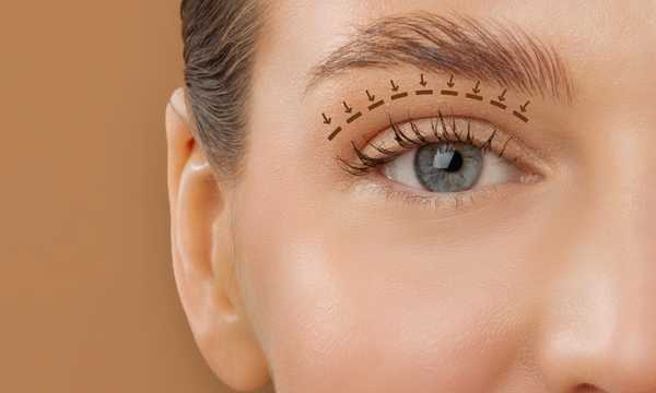 Nici na opadające powieki stosuje się w celu uniesienia opadających powiek bez konieczności klasycznej chirurgii