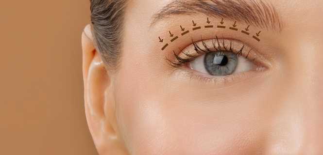 Zastosowanie nici na opadające powieki