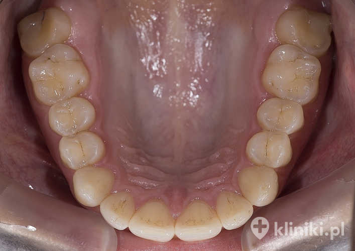 Wędzidełko języka w przypadku utrzymujących się dolegliwości może wymagać konsultacji chirurgicznej lub logopedycznej