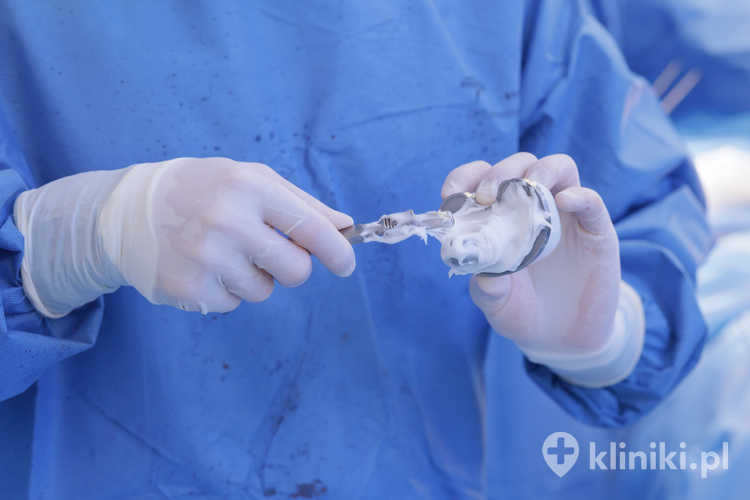 Wybór odpowiednich implantów stosowanych w endoprotezoplastyce stawu kolanowego zależy od wieku pacjenta, jakości kości oraz preferowanej metody mocowania – cementowej lub bezcementowej