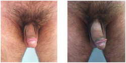 Chirurgia plastyczna męskich narządów płciowych przed i po zabiegu