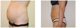 Liposukcja - odsysanie tłuszczu przed i po zabiegu