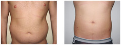 Liposukcja - odsysanie tłuszczu przed i po zabiegu