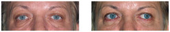 Operacje plastyczne powiek przed i po zabiegu