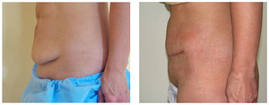 Plastyka ciała (body lifting) przed i po zabiegu