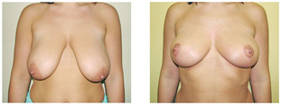 Podniesienie piersi przed i po zabiegu