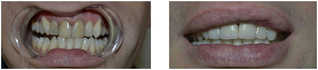 Protetyka stomatologiczna przed i po zabiegu
