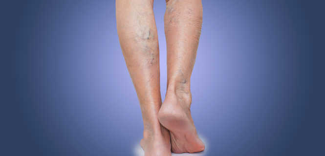 Zamykanie naczynek na nogach