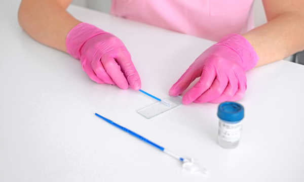 HPV co-test jest nowoczesną metodą oceny ryzyka rozwoju raka szyjki macicy