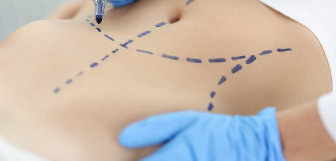 Miniabdominoplastyka – wszystko, co musisz wiedzieć o małym liftingu brzucha