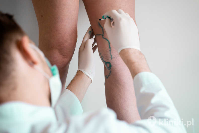 Operacja żylaków z safenektomią ma na celu poprawę krążenia żylnego i zmniejszenie dolegliwości bólowych