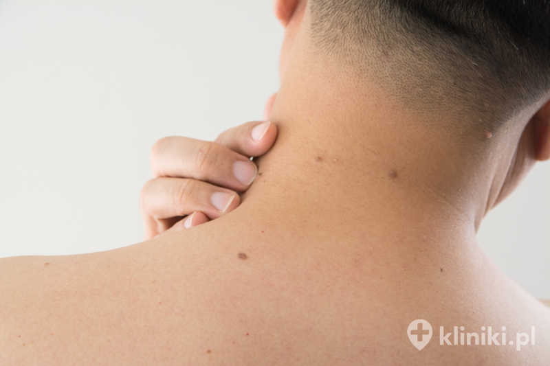 Profesjonalne usuwanie brodawek pozwala na kontrolowany i bezpieczny przebieg terapii