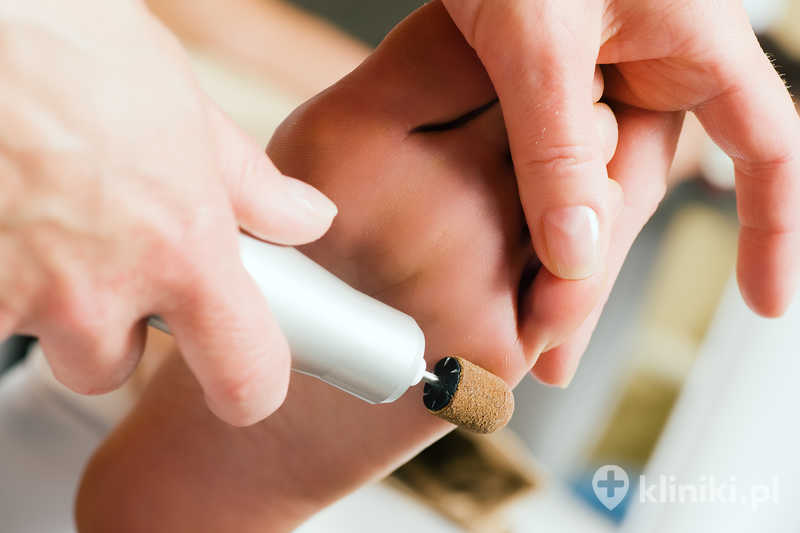 Specjalistyczne opracowanie skóry stóp jest wykonywane w sposób bezpieczny, z użyciem sterylnych narzędzi