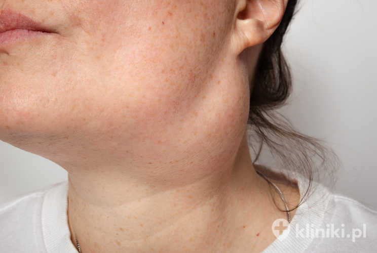 Torbiel boczna szyi jest wrodzoną zmianą torbielowatą powstającą z pozostałości rozwojowych