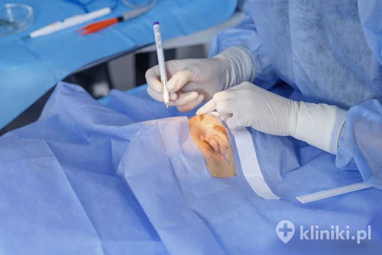 Zabieg korekcji położenia punktów łzowych metodą LAZY-T jest procedurą chirurgiczną stosowaną w leczeniu nadmiernego łzawienia