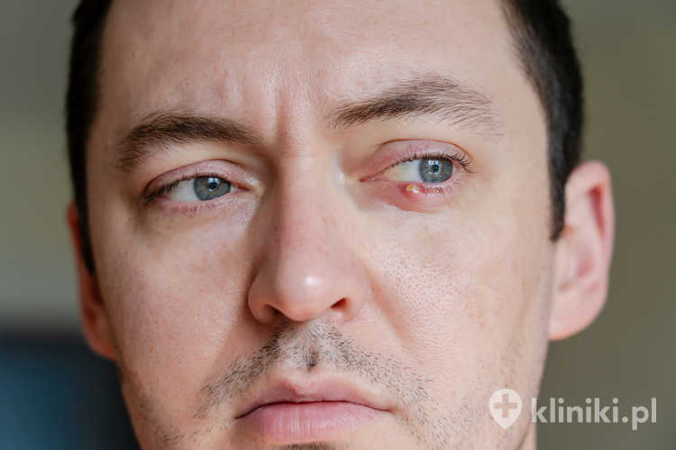 Zabieg rekonstrukcji nieprawidłowo wrastających rzęs poprawia komfort widzenia i zmniejsza dolegliwości bólowe