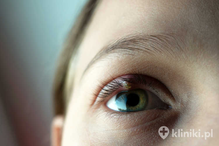 Zabieg rekonstrukcji nieprawidłowo wrastających rzęs wykonywany jest zazwyczaj w znieczuleniu miejscowym