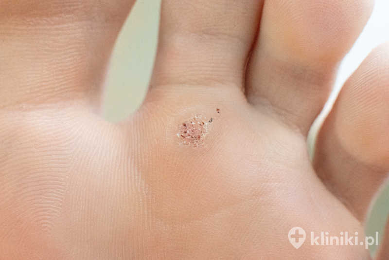 Zabieg usuwania brodawek polega na precyzyjnej aplikacji środka działającego miejscowo na zmianę