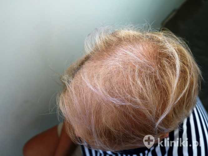 Łysienie u kobiet może przyjmować różne formy, m.in. łysienie androgenowe, telogenowe lub plackowate