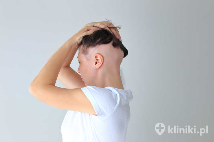 Utrata włosów u kobiet często związana jest także z chorobami tarczycy, niedoborami witamin lub zaburzeniami hormonalnymi