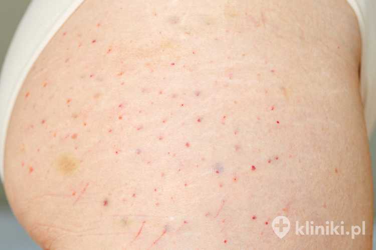 Lipoliza iniekcyjna - po zabiegu