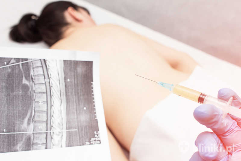 Wertebroplastyka polega na wstrzyknięciu specjalnego cementu kostnego do uszkodzonego kręgu