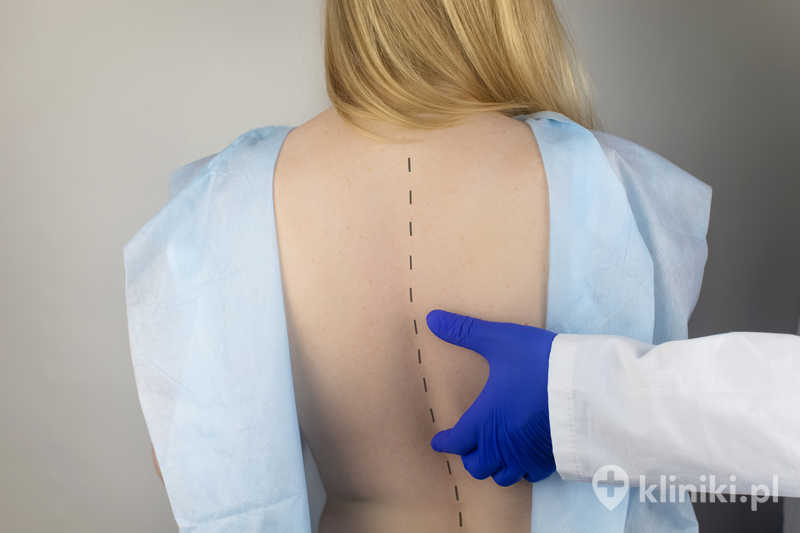 Leczenie złamania kręgosłupa w odcinku piersiowym i lędźwiowym może być zachowawcze