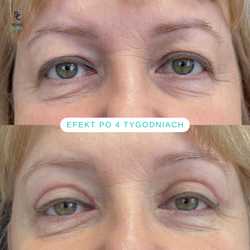Plastyka chirurgiczna powiek górnych przed i po zabiegu