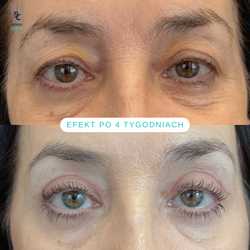 Plastyka chirurgiczna powiek górnych przed i po zabiegu