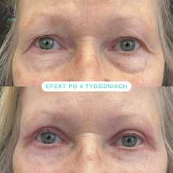 Plastyka chirurgiczna powiek górnych przed i po zabiegu